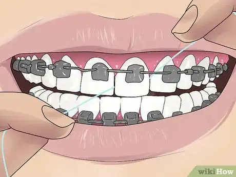 Image titled Floss With Braces Step 9