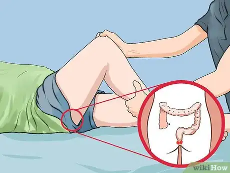 Image titled Treat Hemorrhoids After Pregnancy Step 12