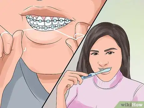 Image titled Prepare for Getting Braces Removed Step 3