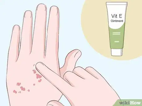 Image titled Heal Scabies Scars Step 5