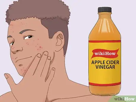 Image titled Get Rid of Acne Fast Step 8