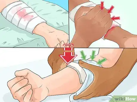 Image titled Apply a Pressure Bandage Step 7