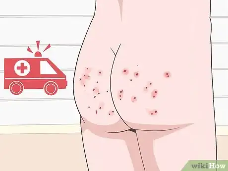 Image titled Treat Buttock Folliculitis Step 6