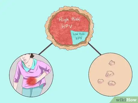 Image titled Recognize HPV in Women (Human Papillomavirus) Step 5