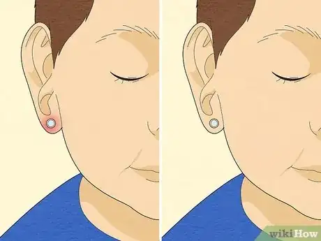 Image titled When to Pierce Baby Ears Step 9