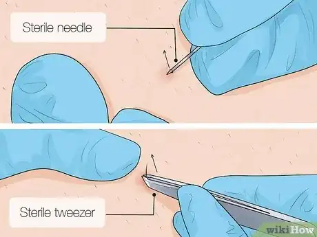 Image titled Remove an Ingrown Hair Step 7