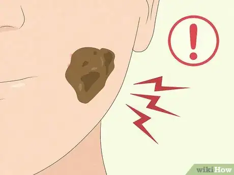 Image titled Treat Acne with Honey and Cinnamon Step 11