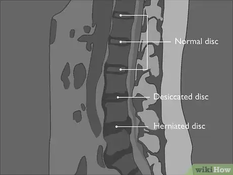 Image titled Read a Lumbar MRI Step 11