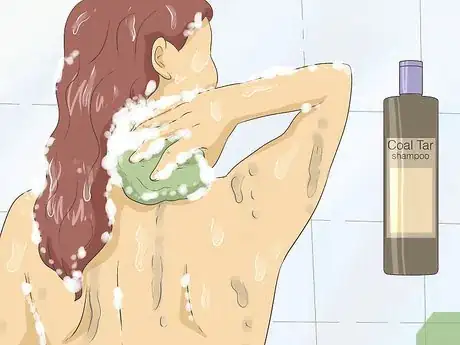 Image titled Get Rid of Psoriasis Step 3