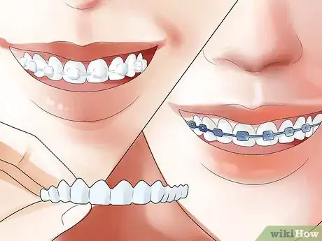 Image titled Determine if You Need Braces Step 18