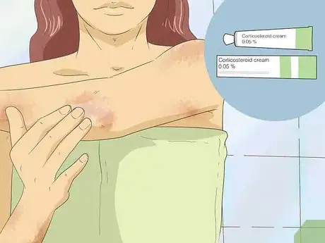 Image titled Get Rid of Psoriasis Step 1