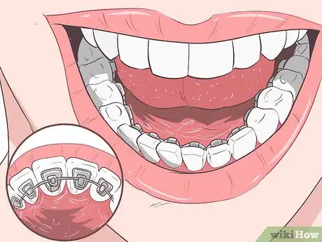 Image titled Hide Braces Step 2