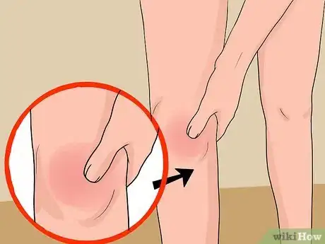 Image titled Treat a Swollen Knee Step 1