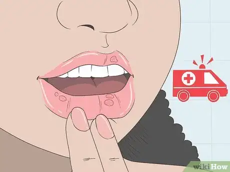 Image titled Treat Cold Sores Inside Your Mouth Step 12