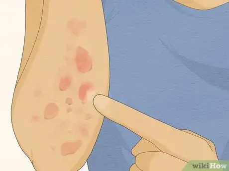 Image titled Recognize Hives (Rash) Step 3