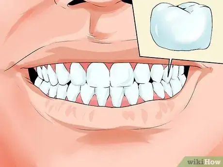 Image titled Avoid Dental Crown Problems Step 1