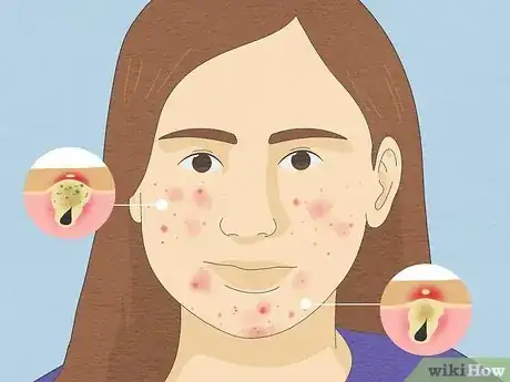 Image titled Tell if Acne Is Hormonal or Bacterial Step 3