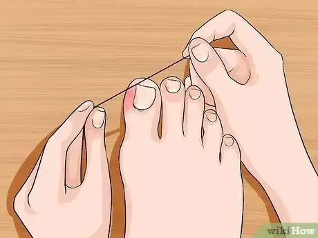 Image titled Relieve Ingrown Toe Nail Pain Step 8