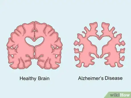 Image titled What Is Glutamate Step 19