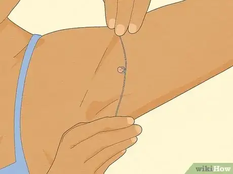 Image titled Get Rid of Skin Tags Step 2