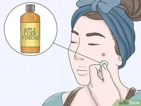 Image titled Bring a Cyst to a Head Step 5