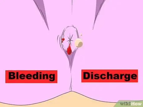 Image titled Diagnose a Fistula Step 2