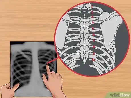 Image titled Read a Chest X Ray Step 4