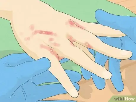 Image titled Recognize Scabies Rash Step 5