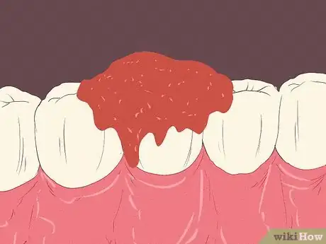 Image titled Get Rid of Tooth Pain Step 10