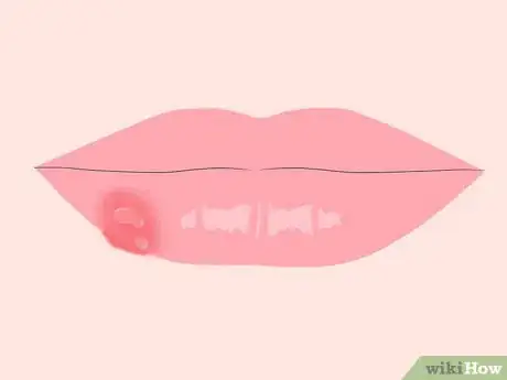 Image titled Get Rid of Mouth Blisters Step 1