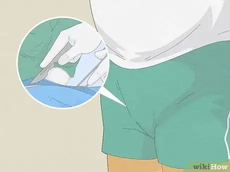 Image titled Know if You Have Epididymitis Step 11