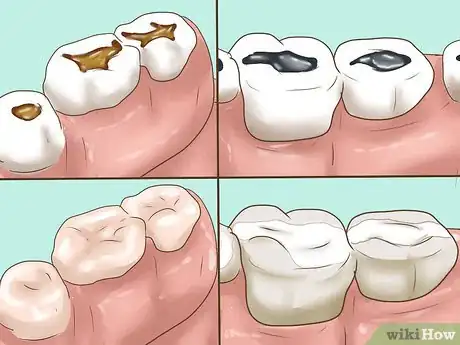 Image titled Know if Your Dental Fillings Need Replacing Step 10