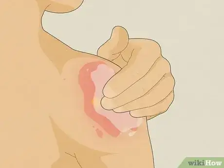 Image titled Use Aloe Vera to Treat Burns Step 4