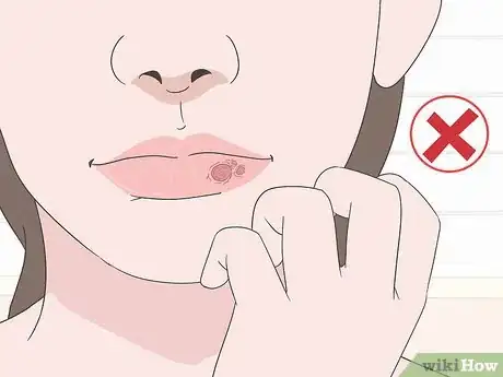 Image titled Cover Up a Cold Sore Step 5