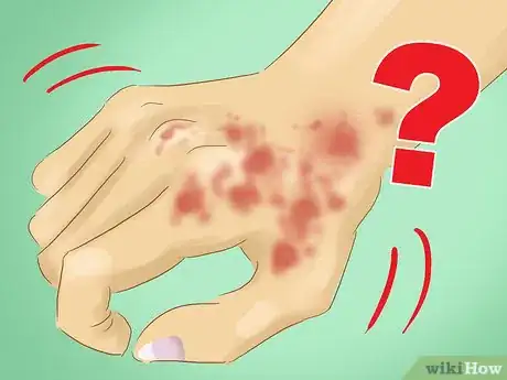 Image titled Diagnose Unusually Cold Hands Step 9