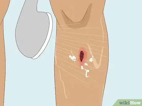 Image titled Apply Different Types of Bandages Step 22