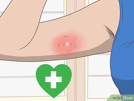 Image titled Get Nexplanon Step 11