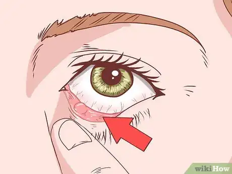 Image titled Make Your Eyes Stop Hurting Step 8