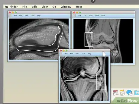 Image titled Read an MRI Step 14