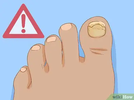 Image titled Help a Toenail Grow Back Quickly Step 15