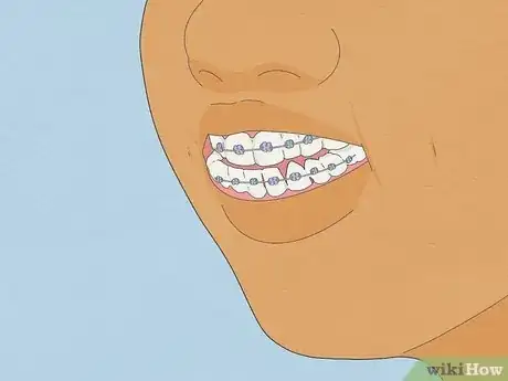 Image titled Straighten Your Teeth Without Braces Step 4