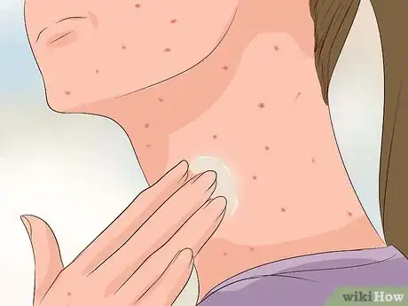 Image titled Recognize Chickenpox Step 13