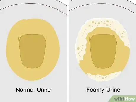 Image titled Reduce Foamy Urine Step 1