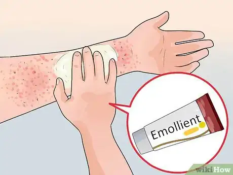 Image titled Treat Contact Dermatitis Step 2