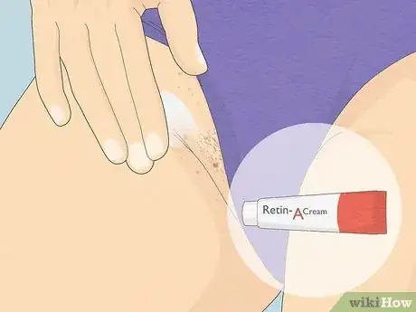 Image titled Get Rid of Razor Bumps in the Bikini Area Step 5