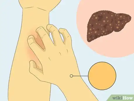 Image titled Treat Liver Fibrosis Step 10