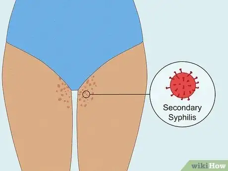 Image titled Get Rid of a Rash Between Your Legs Step 13