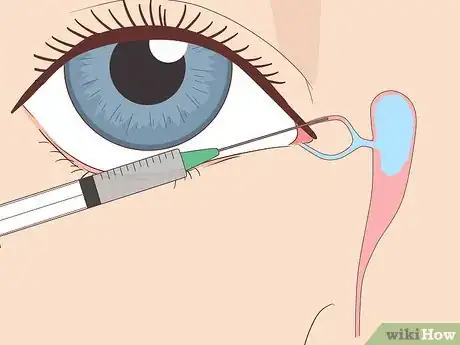 Image titled Clear a Blocked Tear Duct Step 10