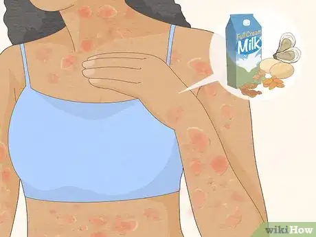 Image titled Recognize Hives (Rash) Step 5