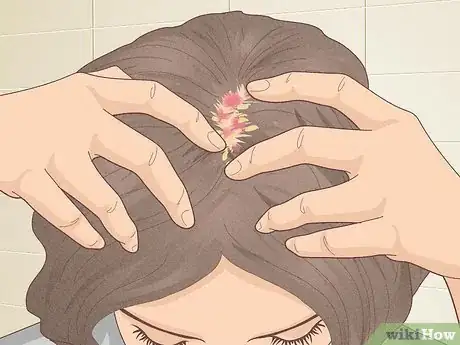 Image titled Bumps on Scalp Step 16